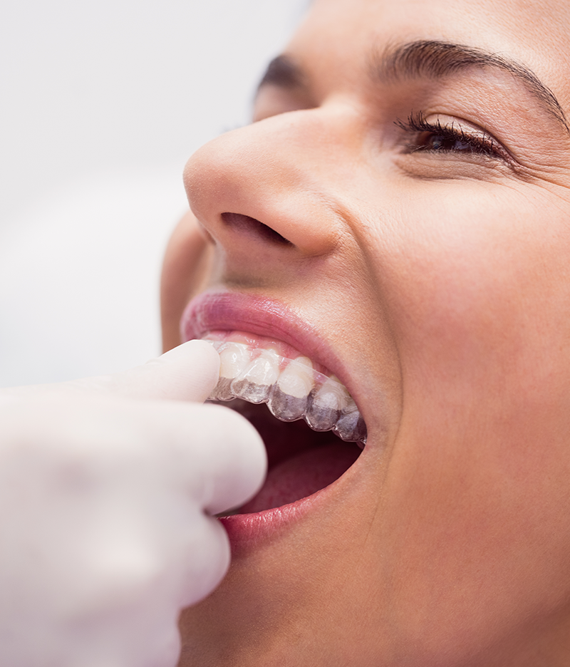 alineadores invisibles dientes perfectos sonrisa dentadura